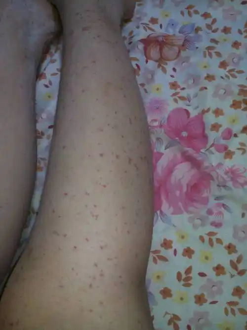 紫癜,之前没有过病史,腿上久坐久立就会出现新的小紫癜,怎样好的快