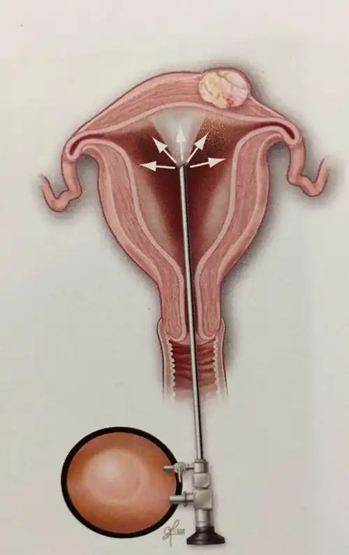 非常给力的子宫"大内高手"