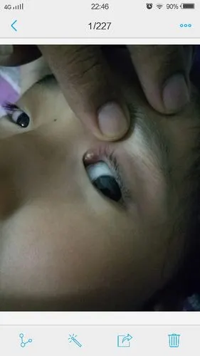 小孩眼角长了白点,能不能挤啊!还是滴眼液就可以好.