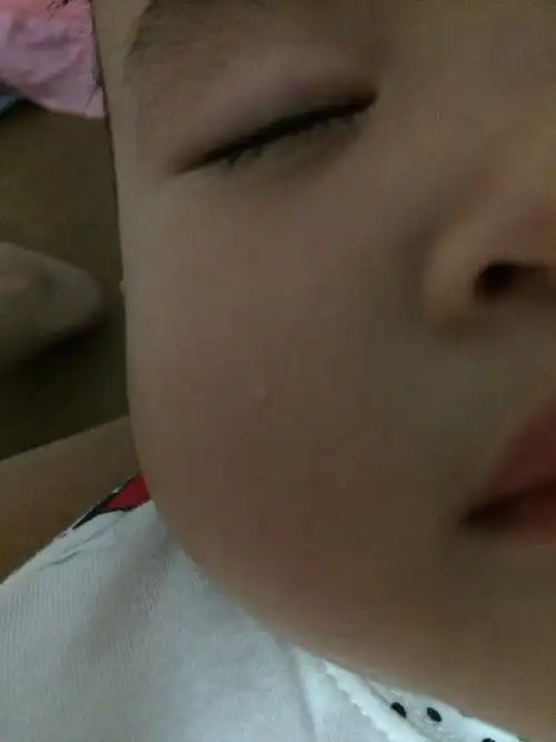 我家宝宝脸上长了颗脂肪粒,长大后会不会消除