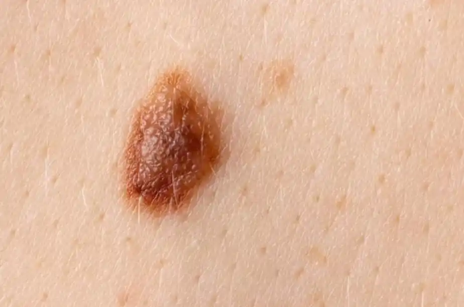 年轻生命的陨落:黑痣与黑色素瘤,你需要知道的区别