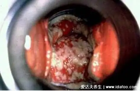 如图,如果白带异常增多,呈豆腐渣的样子,那么警惕是患上霉菌性阴炎了