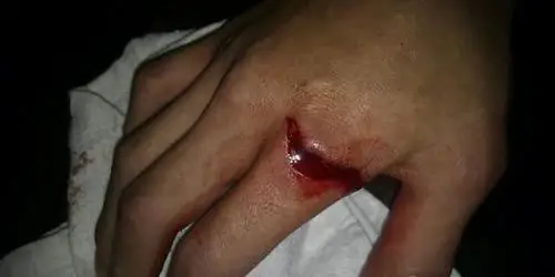 安志杰洗碗手受伤缝7针谢婷婷相陪