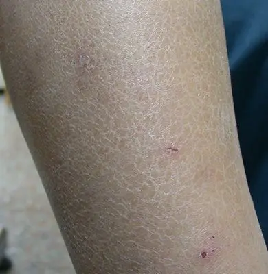 干燥性湿疹),这种皮肤表面脂质减少所引起的典型湿疹,最常让人误以为