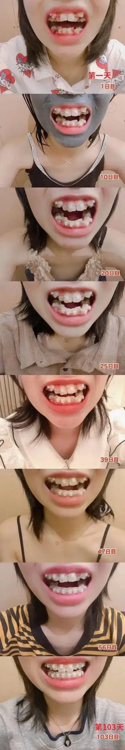 整牙如整容日本16岁樱花妹花百日矫正牙齿结果惊人