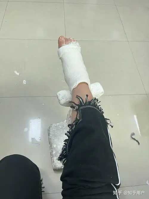 拆掉了前一天打上的石膏(半边石膏),等待医生复位和打石膏.2.