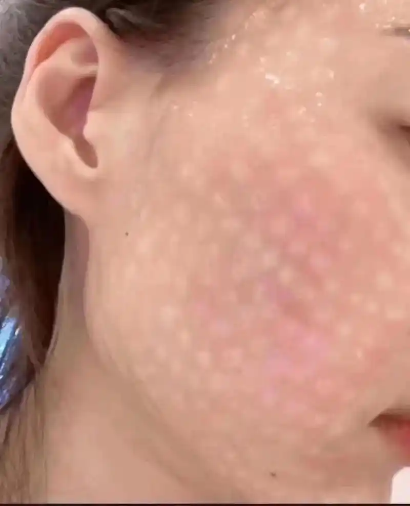 水光针91一月一打 水光针注射周期是20-30天一次 3-5 - 抖音