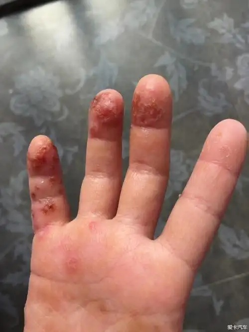 求助女儿手部湿疹反复两年多了最近越发严重了