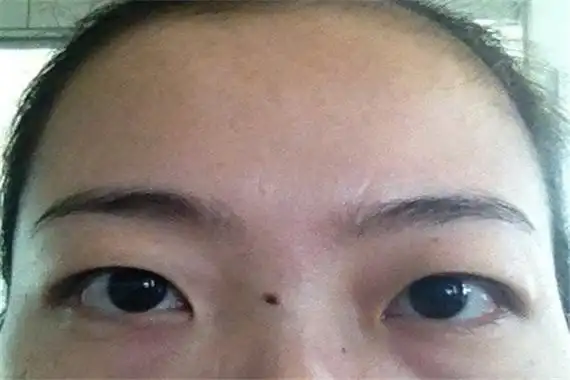 刀厄痣要不要去掉刀厄痣过大病变几率大最好去掉