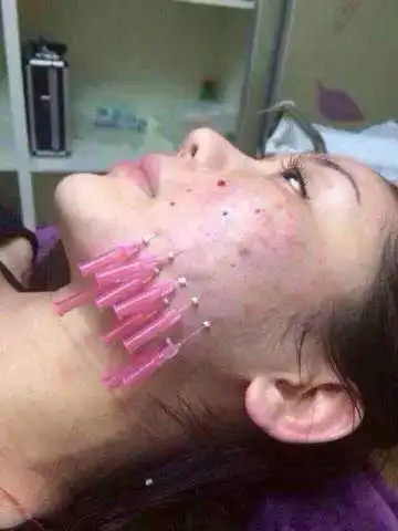 线雕的价位是多少?术后有副作用吗?