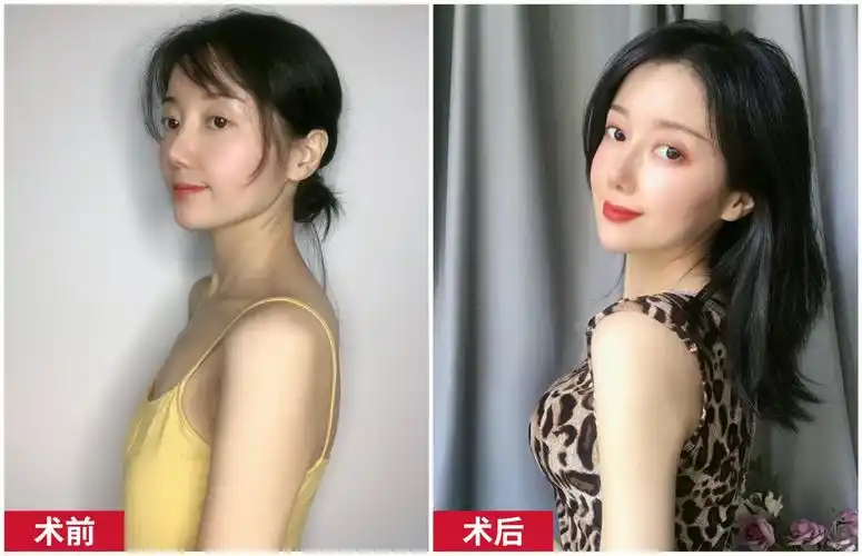 更年期乳房萎缩下垂,没有其他不适,需要看医生吗?