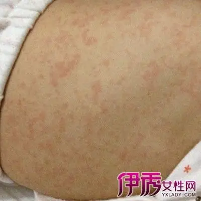【图】宝宝发烧后出疹子图片展示 教你分辨各类幼儿疹子