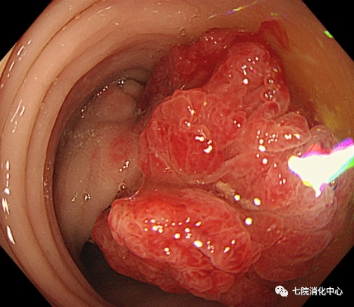 结肠息肉需警惕,内镜帮您来搞定_结肠息肉_介绍_如何预防_治疗方式