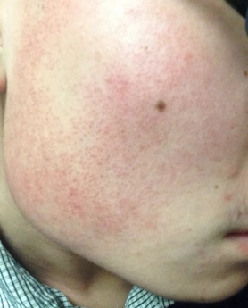 脸部毛周角化怎么办 还您自信的小偏方