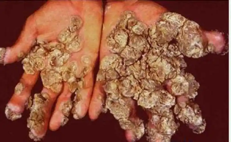 青海疣医院_青海治疗疣哪家医院好_青海治疗疣最好的