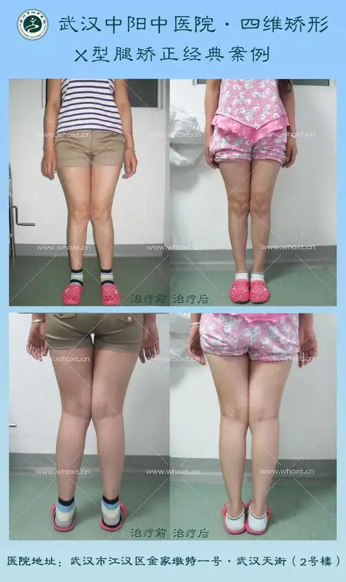 为什么会有x型腿?武汉中阳中医院四维矫形技术矫正