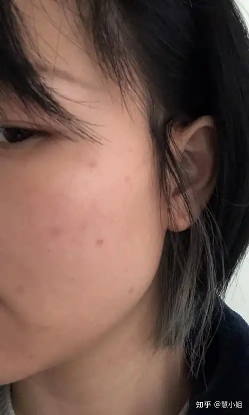 点痣后恢复期 - 知乎