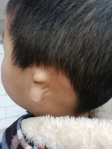 【美丽蜕变】先天小耳缺陷 丽都终圆耳梦_耳朵畸形国家有免费_北京