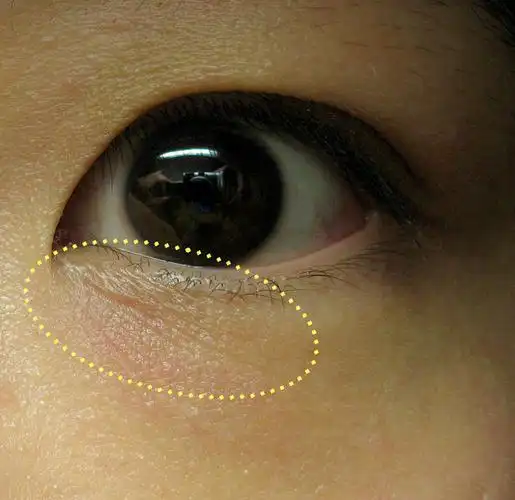 1秒钟 爱美眉如何快速辨别眼部真假细纹?