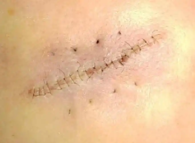 美容缝合(上)解析远位缝合"lbd"缝合 整形医生高良杰_伤口_切口_张力