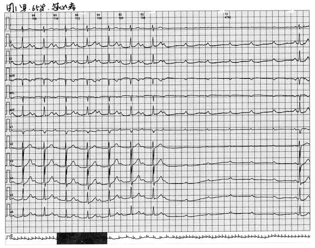 心悸,头晕等症状,对应的动态心电图室心室停搏