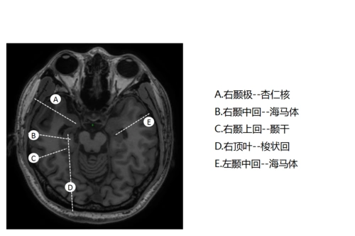 术中电极位置2017年,山西省人民医院神经外科功能脑性疾病专家组马久