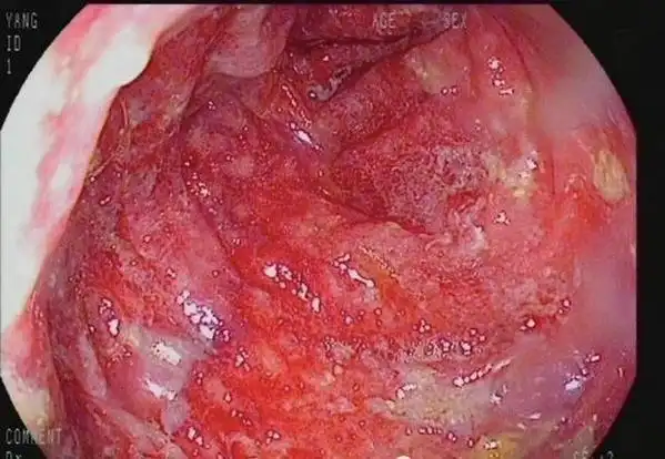 1,胃,食管疾病导致便血 症状表现:一般便血不是鲜红色,而是有些泛黑