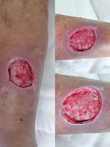 骨伤科 感染创面修复2例