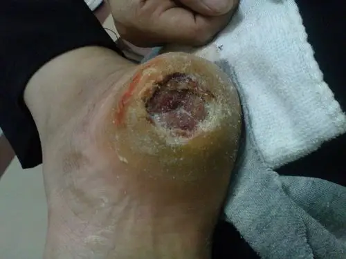 大家看看这个是什么病