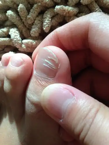 两只脚的大拇指甲盖有断层,好长时间了.