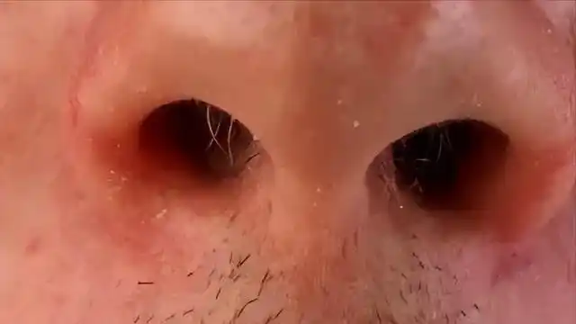 鼻毛旺盛说明了什么?能不能拔掉?