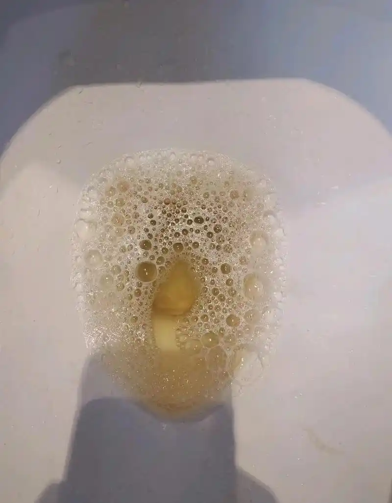 尿液有泡沫,味道大,是肾脏问题吗?教你自测三步法,准确找到病因!