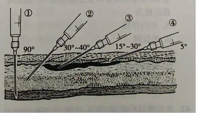 皮下注射的进针角度如图所示为