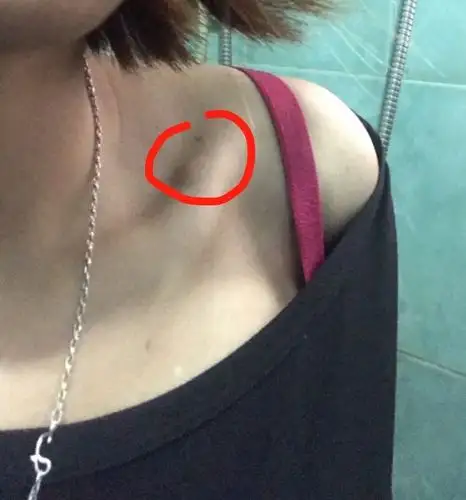 右侧锁骨淋巴结一个