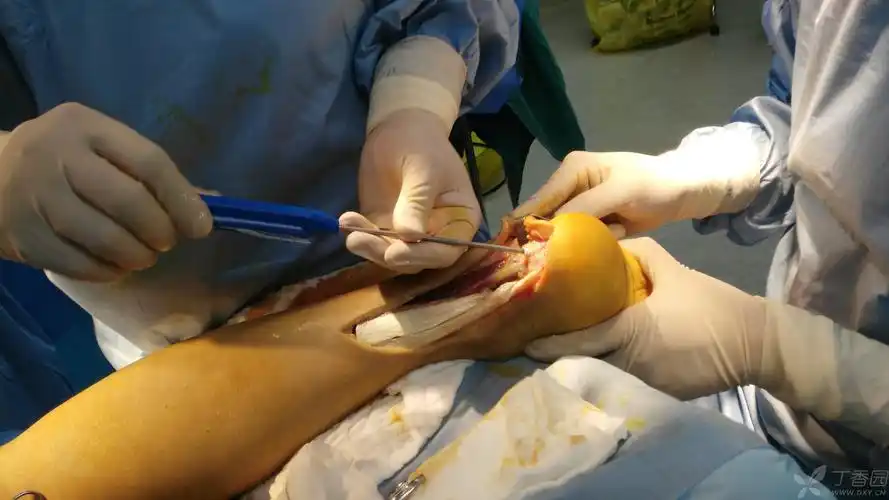 止点性跟腱炎并断裂,病灶切除并踇长屈肌重建跟腱手术一例 [病例帖]