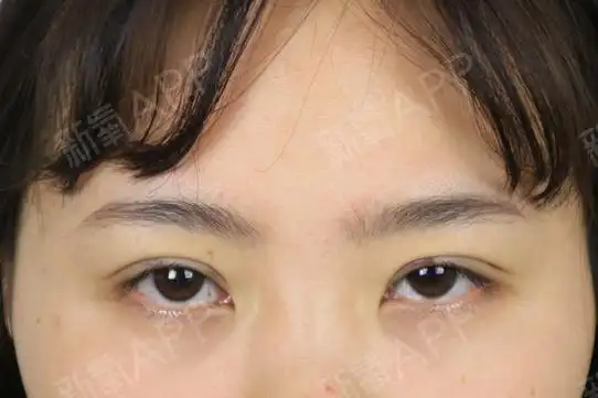 今天给大家带来一则"三角眼"的案例~妹子是天生的肿_圈子-新氧美容