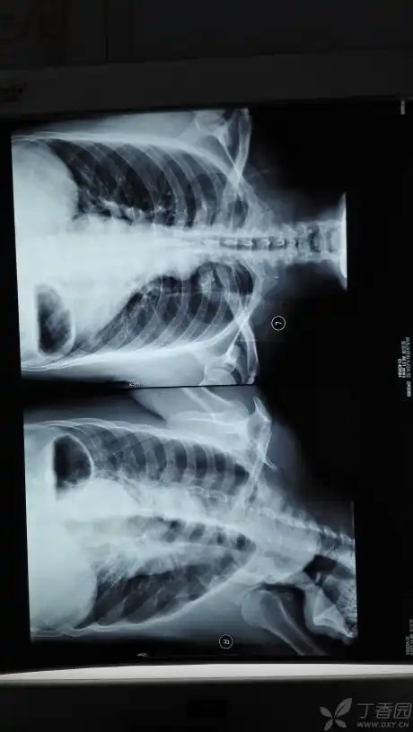 临床吐槽一下肋骨骨折吧 [病例帖]