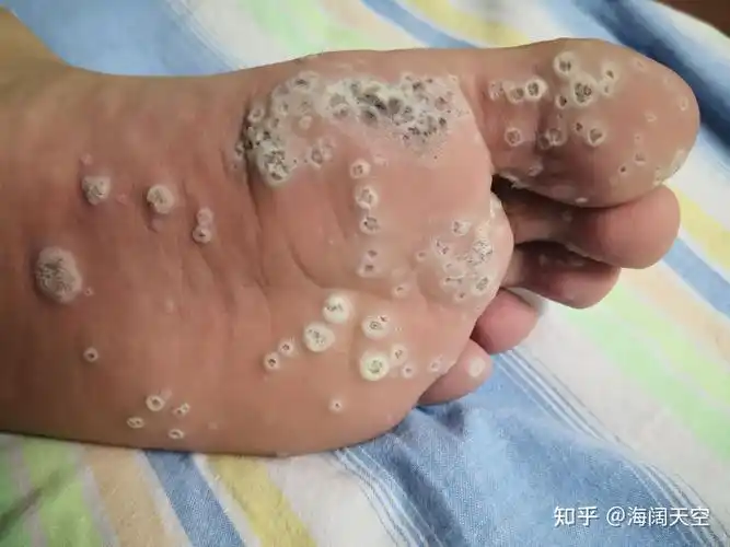 草药不愧是国粹跖疣用无痛方法照样可以治好