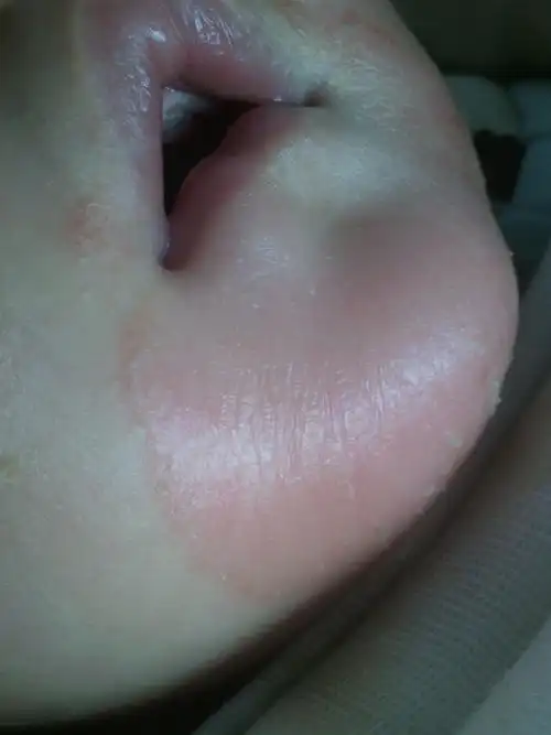 你好医师,我的孩子《5个月了》颚下巴出现不良症状,下颚《发红起水泡