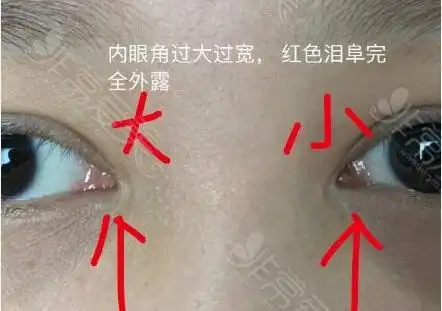 泪阜暴露过多,眼角漏红;一般内眼角开过大的表现有如下两点:内眼角回