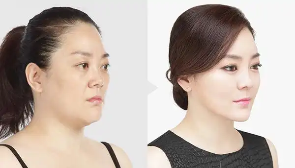 自体脂肪填充解决眼部凹陷