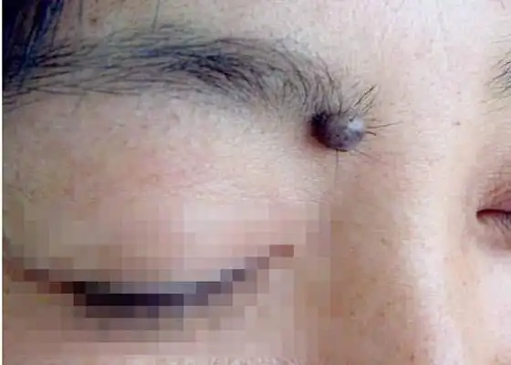 黑痣癌变的早期图片56