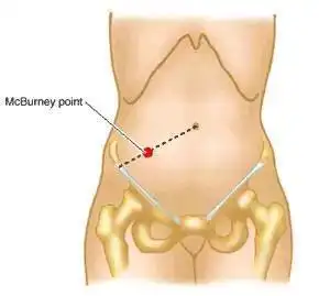 1,右下腹压痛:是阑尾炎常见的重要体征,压痛点通常在麦氏点,但可随