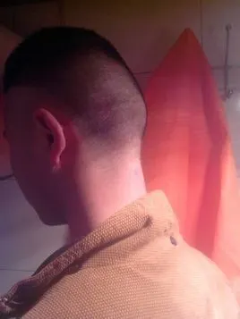 名词)枕骨隆突,先天生成的,每个人都有,只是有些人比较突出而已,不是