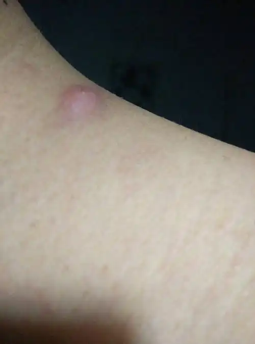 耳朵后边的皮脂腺囊肿图片