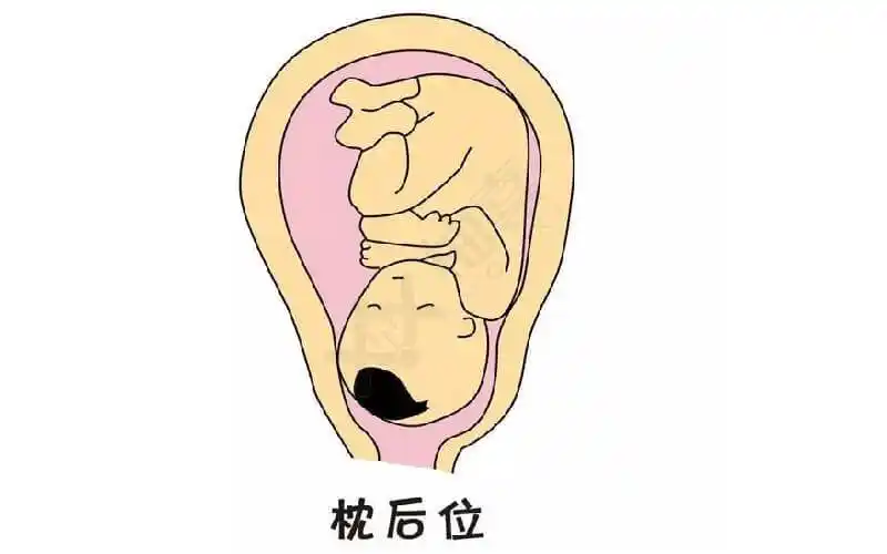 揭秘枕后位孕妇能否顺产,背后的风险不得不了解