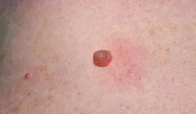 红痣是什么征兆_红痣