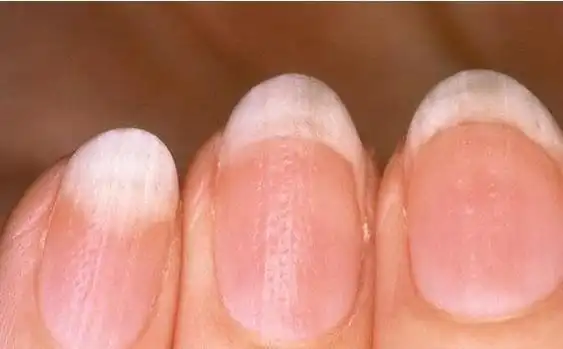 缺铁性贫血的人,手指甲会会出现明显异常反应