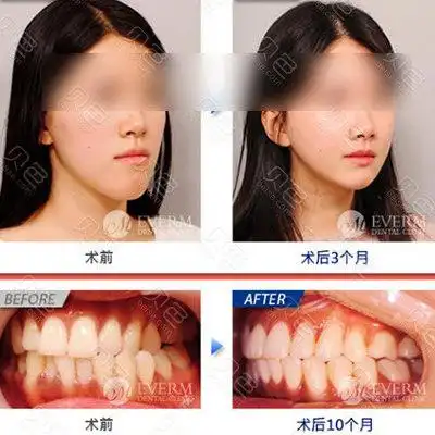 正颌手术费用一般是多少钱,为什么医生不建议做正颌手术?