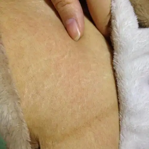 生了孩子,肚子就这样了,这是白癜风还是妊娠纹